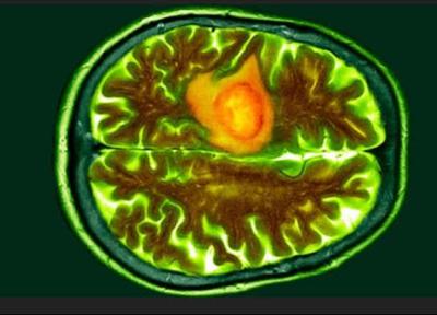 آزمایش خون جدیدی که یک نوع سرطان مغزی مرگبار را در یک ساعت شناسایی می نماید