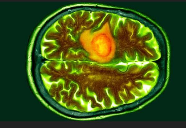 آزمایش خون جدیدی که یک نوع سرطان مغزی مرگبار را در یک ساعت شناسایی می نماید